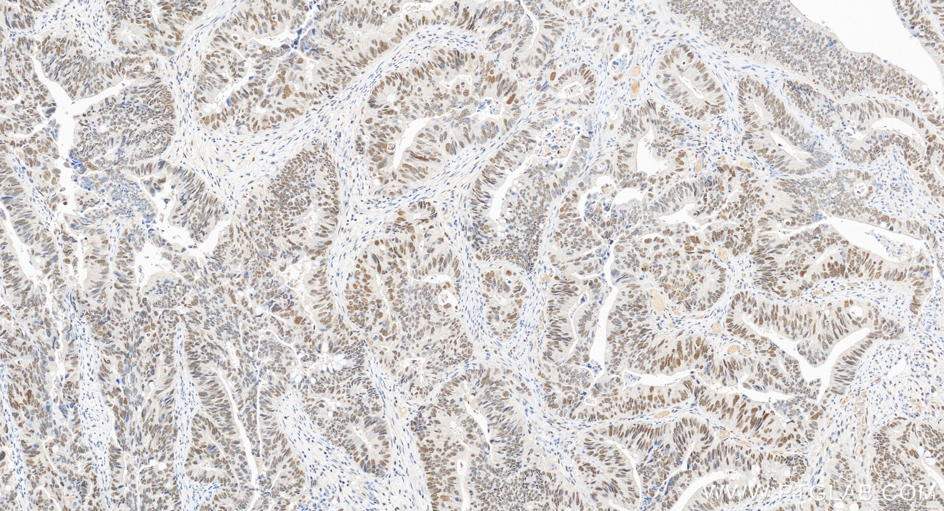 Immunohistochemistry (IHC) staining of human colon cancer tissue using PMS2 Recombinant monoclonal antibody (84894-5-RR)