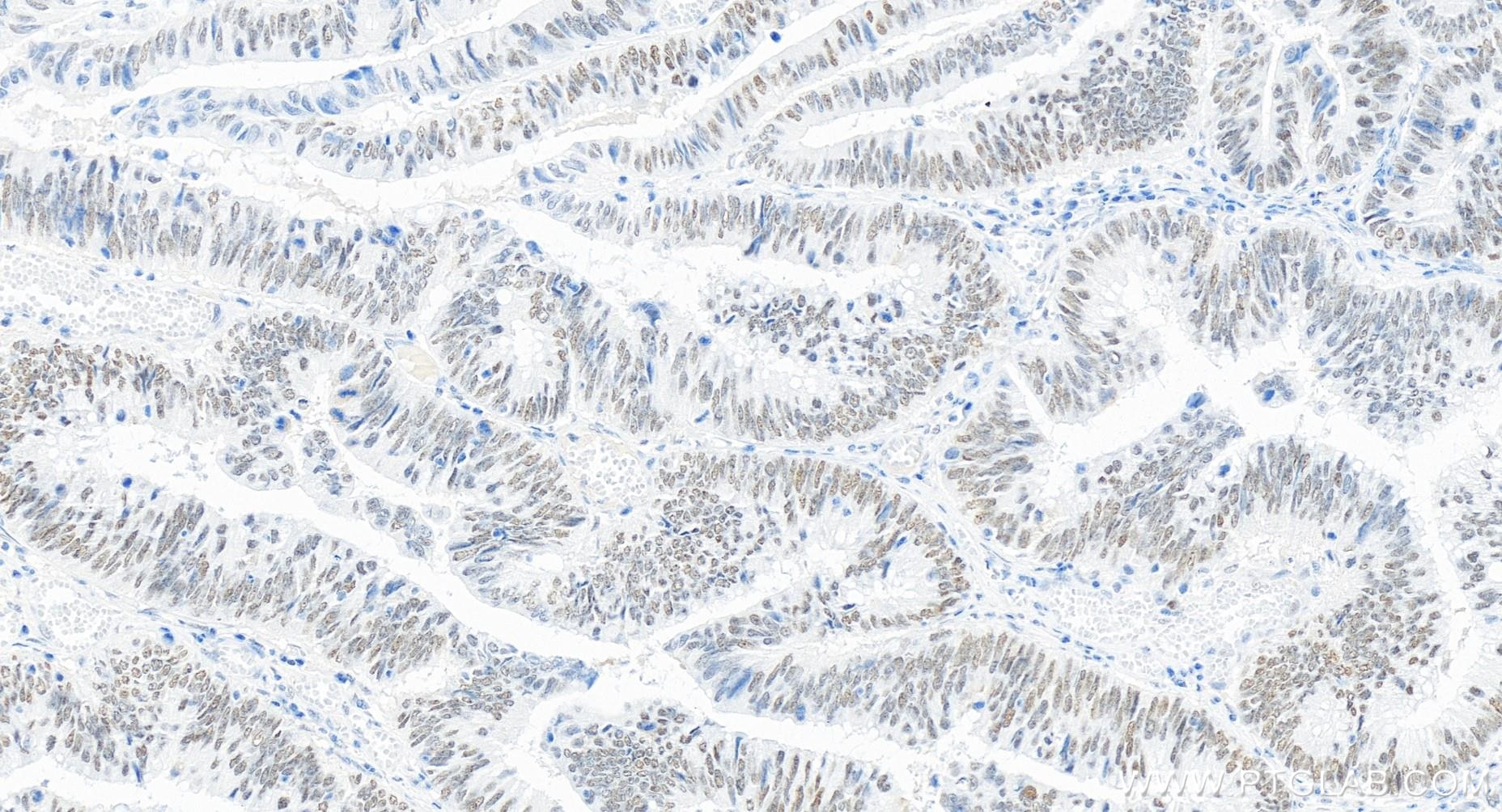 Immunohistochemistry (IHC) staining of human colon cancer tissue using PMS2 Recombinant antibody (84894-5-RR)
