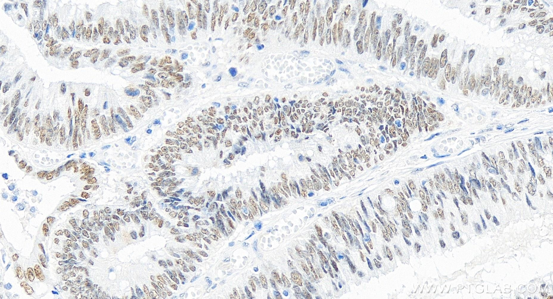 Immunohistochemistry (IHC) staining of human colon cancer tissue using PMS2 Recombinant antibody (84894-5-RR)