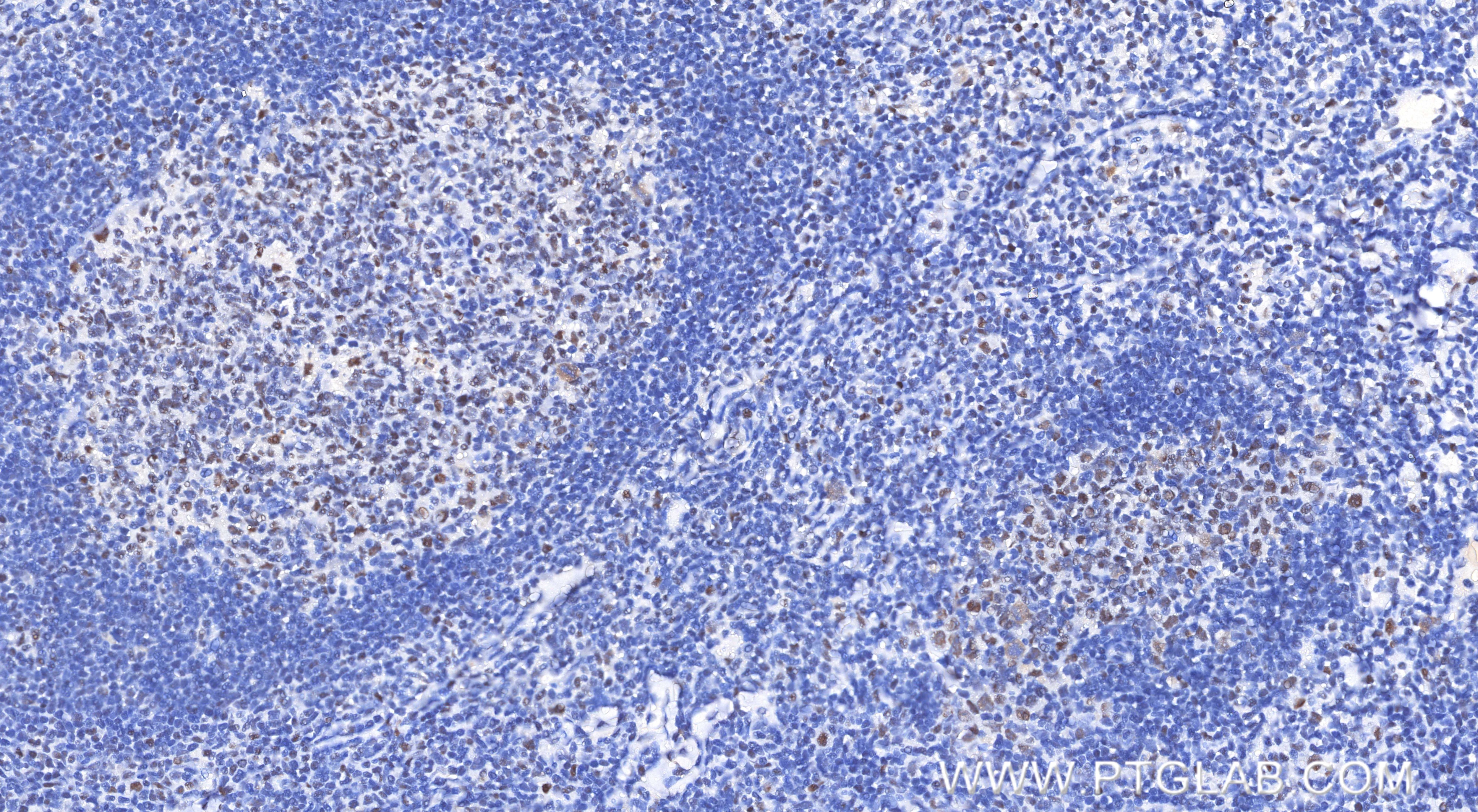 Immunohistochemical analysis of paraffin-embedded human tonsil tissue slide using 84894-5-RR (PMS2 antibody) at dilution of 1:400 (under 20x lens). Heat mediated antigen retrieval with Tris-EDTA buffer (pH 9.0). Immunohistochemistry (IHC) staining of human tonsil tissue using PMS2 Recombinant monoclonal antibody (84894-5-RR)