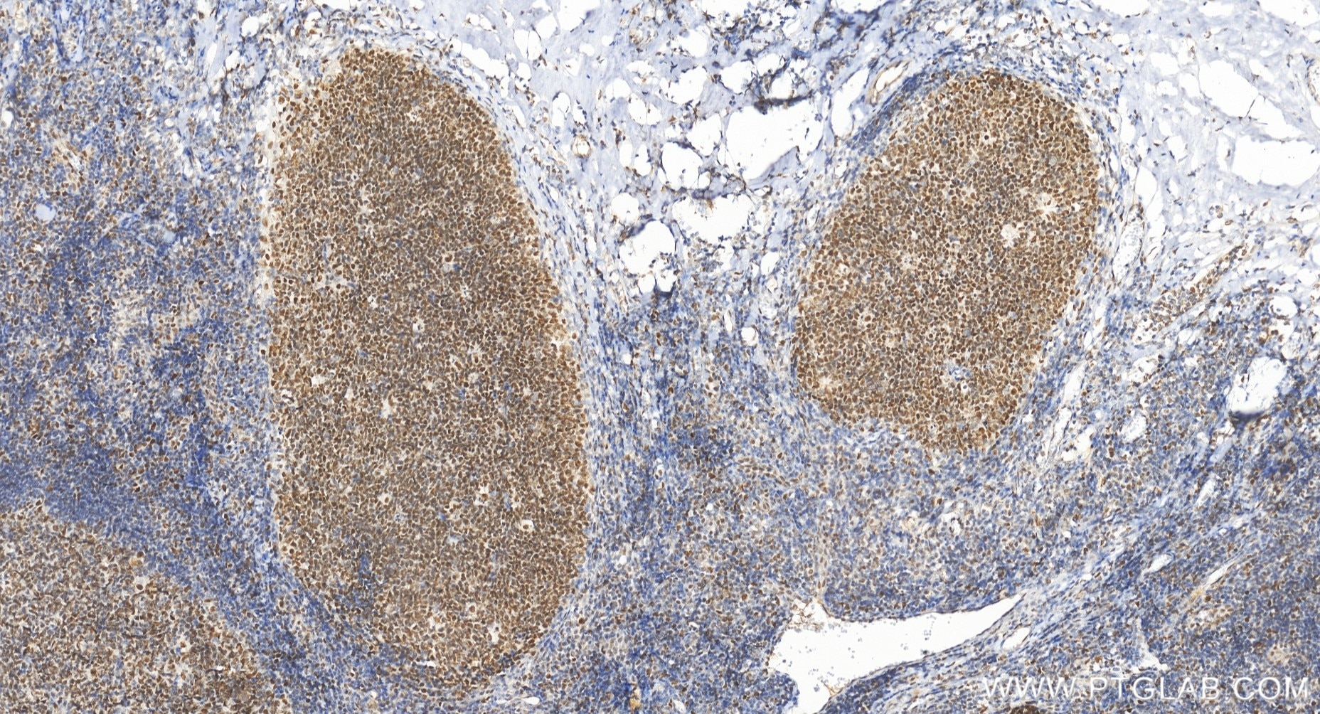 Immunohistochemistry (IHC) staining of human tonsillitis tissue using PMS2 Recombinant monoclonal antibody (84894-5-RR)