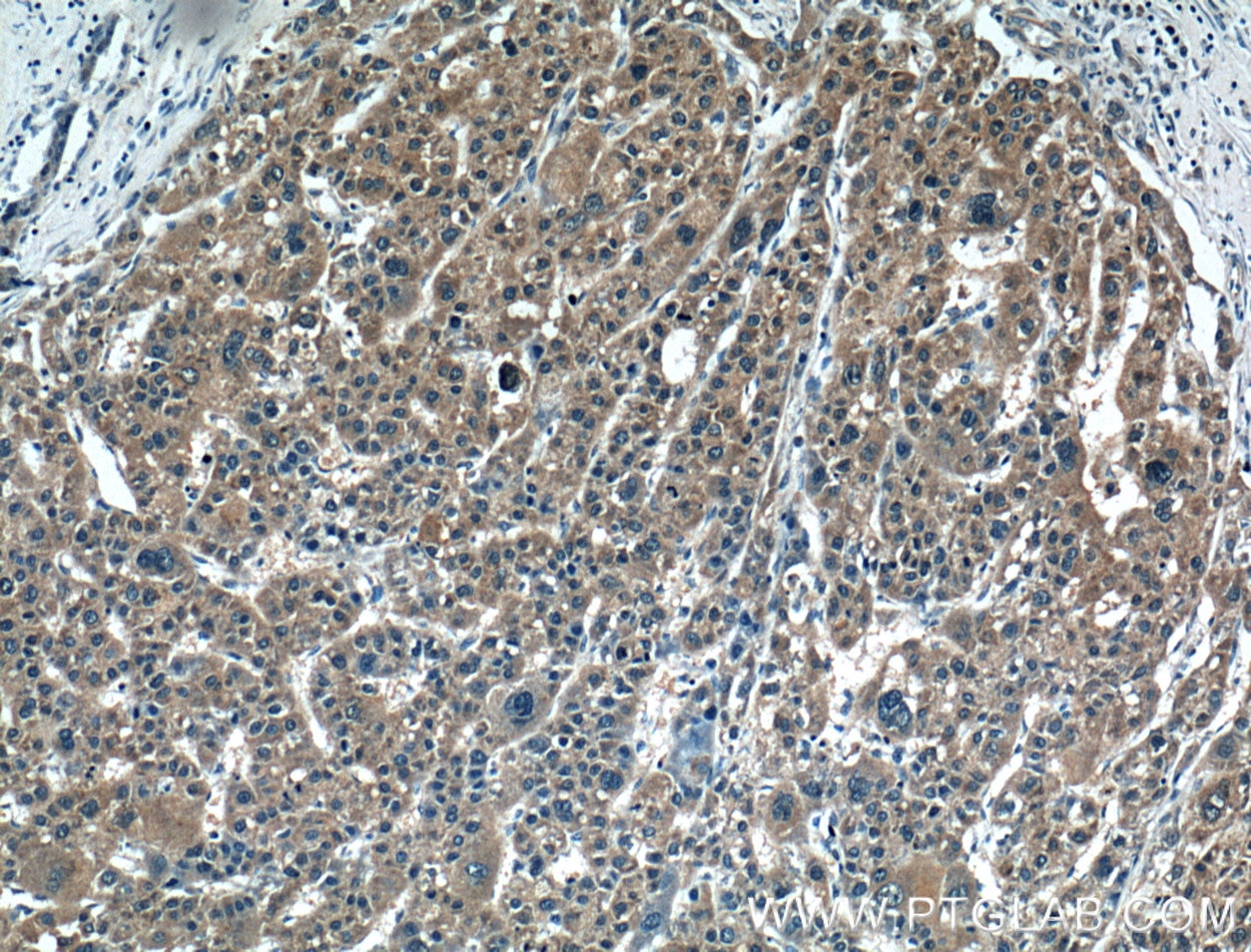 Immunohistochemistry (IHC) staining of human liver cancer tissue using PMVK Polyclonal antibody (15674-1-AP)