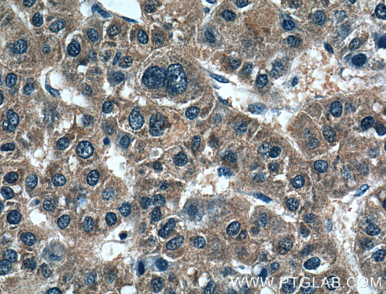 Immunohistochemistry (IHC) staining of human liver cancer tissue using PMVK Polyclonal antibody (15674-1-AP)