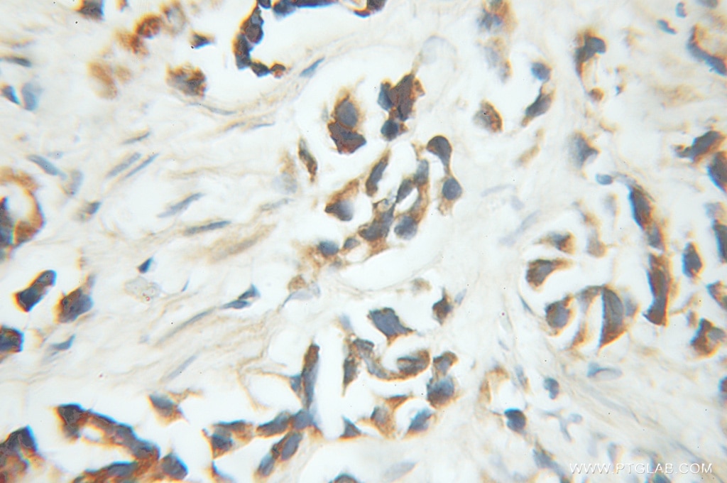 Immunohistochemistry (IHC) staining of human prostate cancer tissue using PNKD Polyclonal antibody (11584-1-AP)