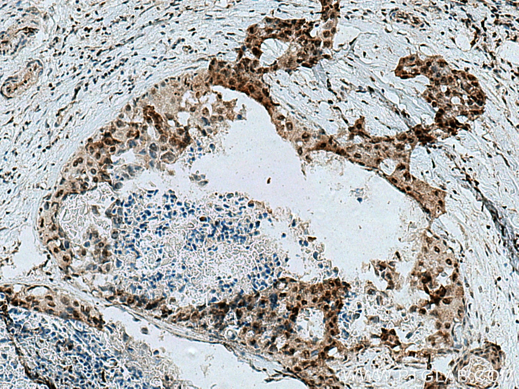 Immunohistochemistry (IHC) staining of human breast cancer tissue using PNKP Polyclonal antibody (13558-1-AP)