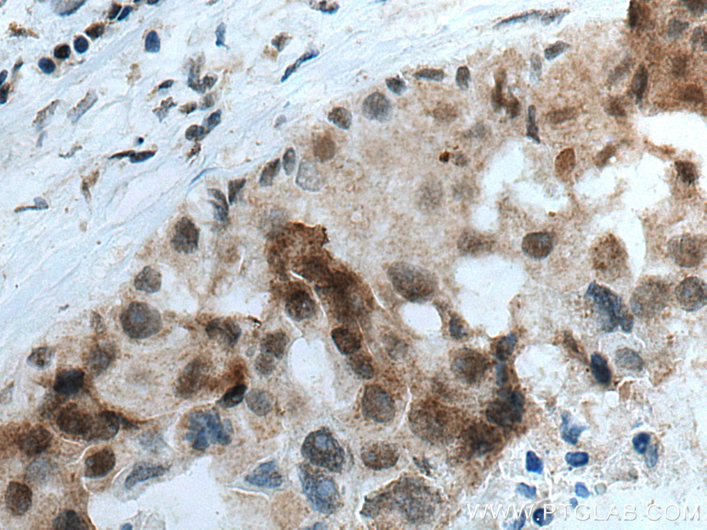 Immunohistochemistry (IHC) staining of human breast cancer tissue using PNKP Polyclonal antibody (13558-1-AP)