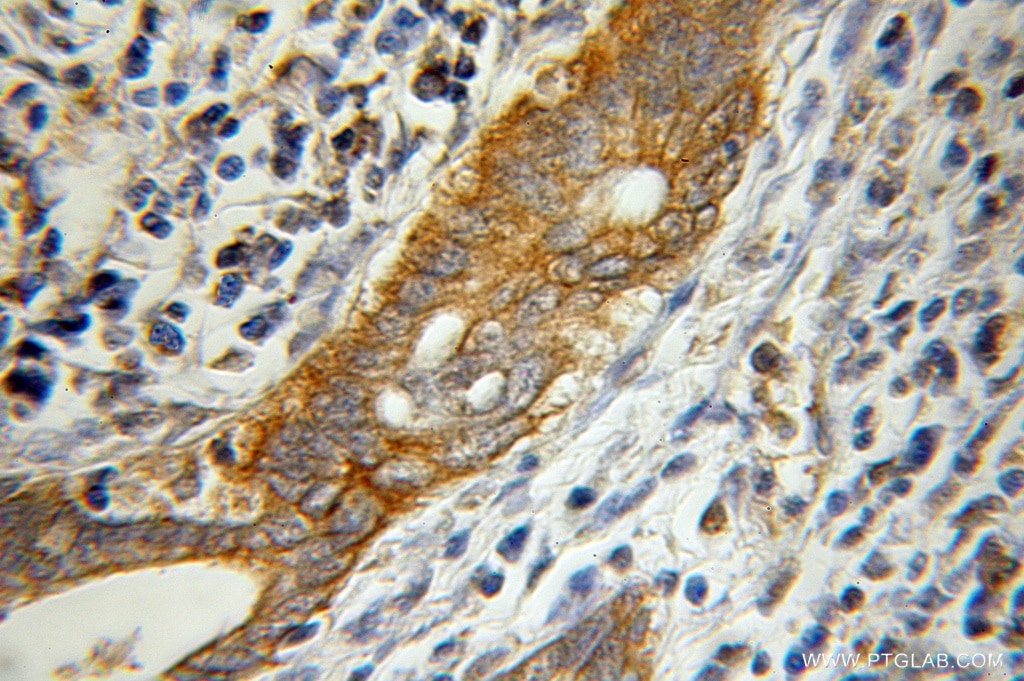 Immunohistochemistry (IHC) staining of human pancreas cancer tissue using Pancreatic Lipase Polyclonal antibody (11209-1-AP)