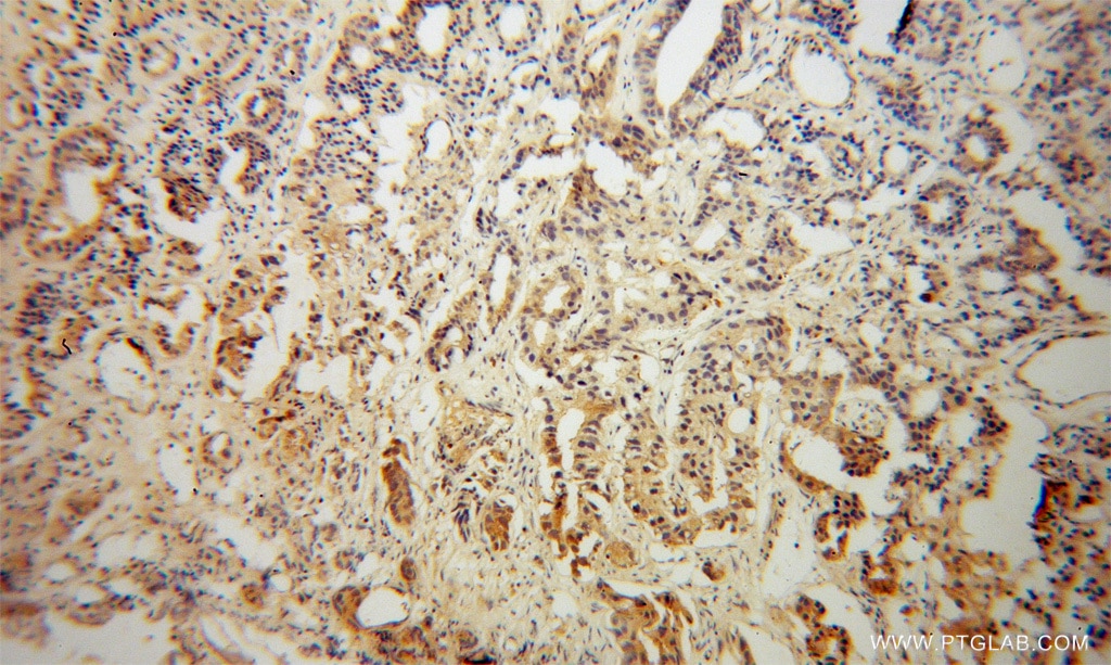 Immunohistochemistry (IHC) staining of human gliomas tissue using PNMA1 Polyclonal antibody (13631-1-AP)