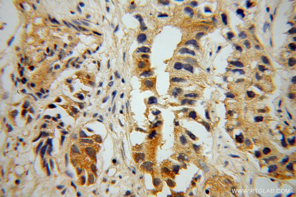 Immunohistochemistry (IHC) staining of human gliomas tissue using PNMA1 Polyclonal antibody (13631-1-AP)