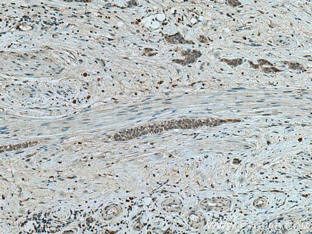 Immunohistochemistry (IHC) staining of human urothelial carcinoma tissue using PNO1 Polyclonal antibody (21059-1-AP)