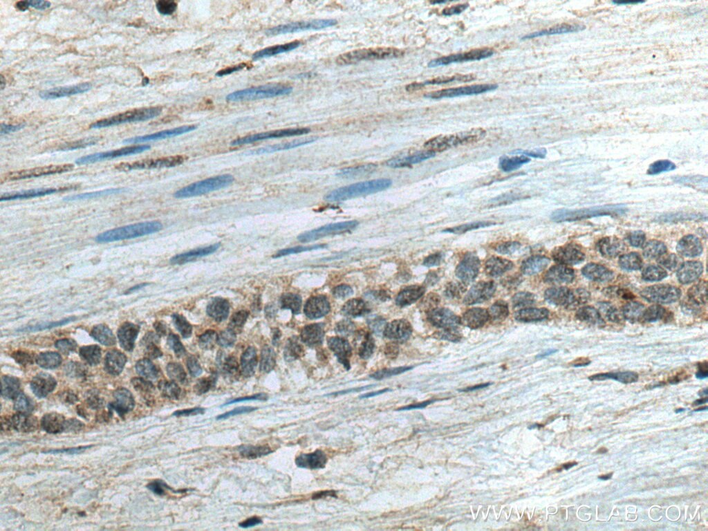Immunohistochemistry (IHC) staining of human urothelial carcinoma tissue using PNO1 Polyclonal antibody (21059-1-AP)