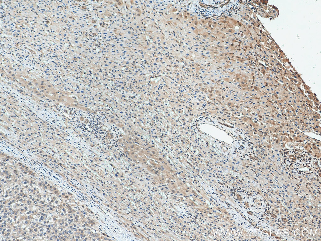 Immunohistochemistry (IHC) staining of human liver cancer tissue using PNO1 Polyclonal antibody (21059-1-AP)