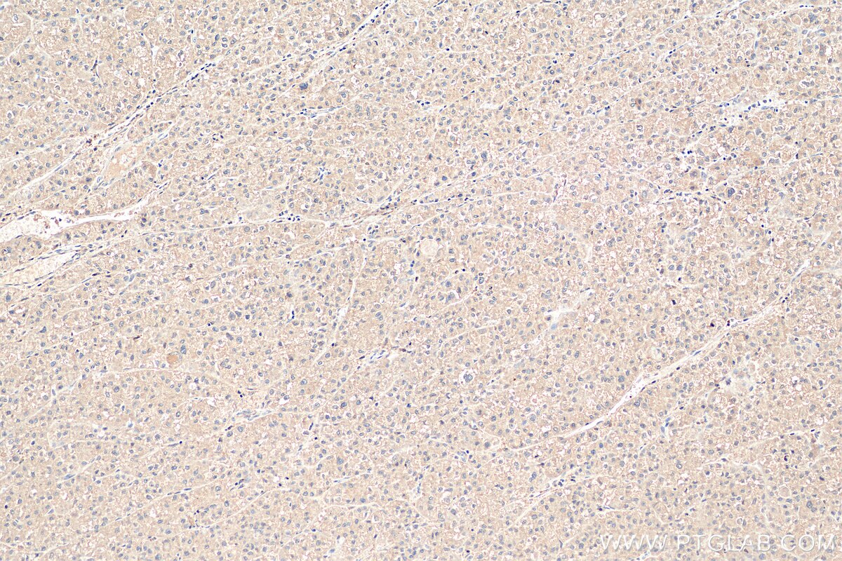 Immunohistochemistry (IHC) staining of human liver cancer tissue using PNPLA3 Polyclonal antibody (11442-1-AP)