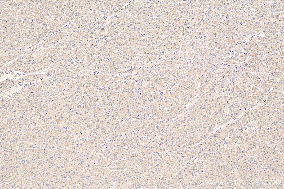 Immunohistochemistry (IHC) staining of human liver cancer tissue using PNPLA3 Polyclonal antibody (11442-1-AP)