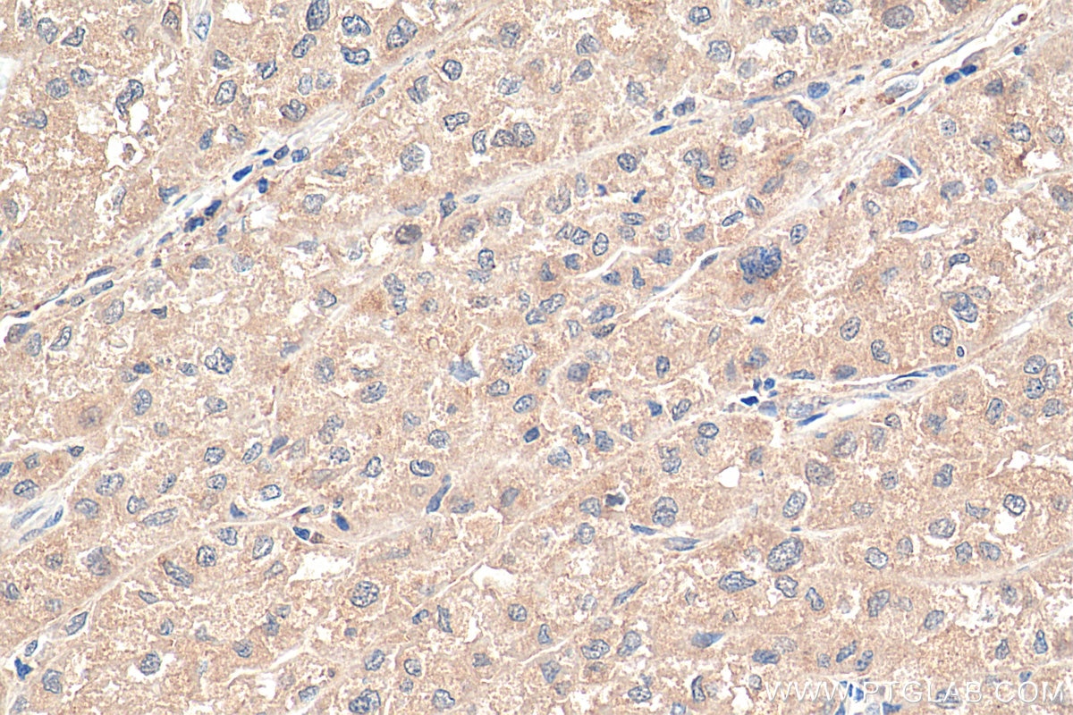 Immunohistochemistry (IHC) staining of human liver cancer tissue using PNPLA3 Polyclonal antibody (11442-1-AP)