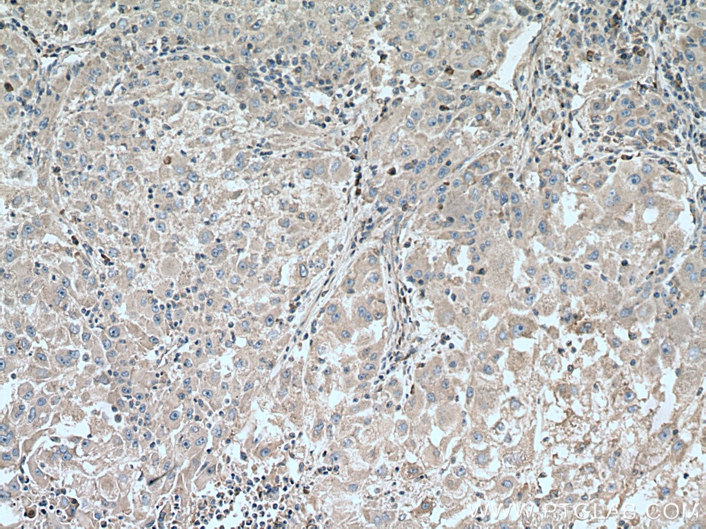 Immunohistochemistry (IHC) staining of human liver cancer tissue using PNPLA3 Monoclonal antibody (67369-1-Ig)