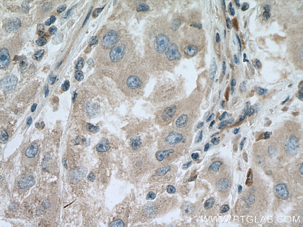 Immunohistochemistry (IHC) staining of human liver cancer tissue using PNPLA3 Monoclonal antibody (67369-1-Ig)