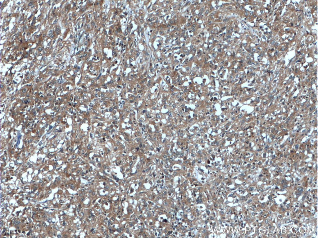 Immunohistochemistry (IHC) staining of human cervical cancer tissue using PNPLA4 Polyclonal antibody (25469-1-AP)