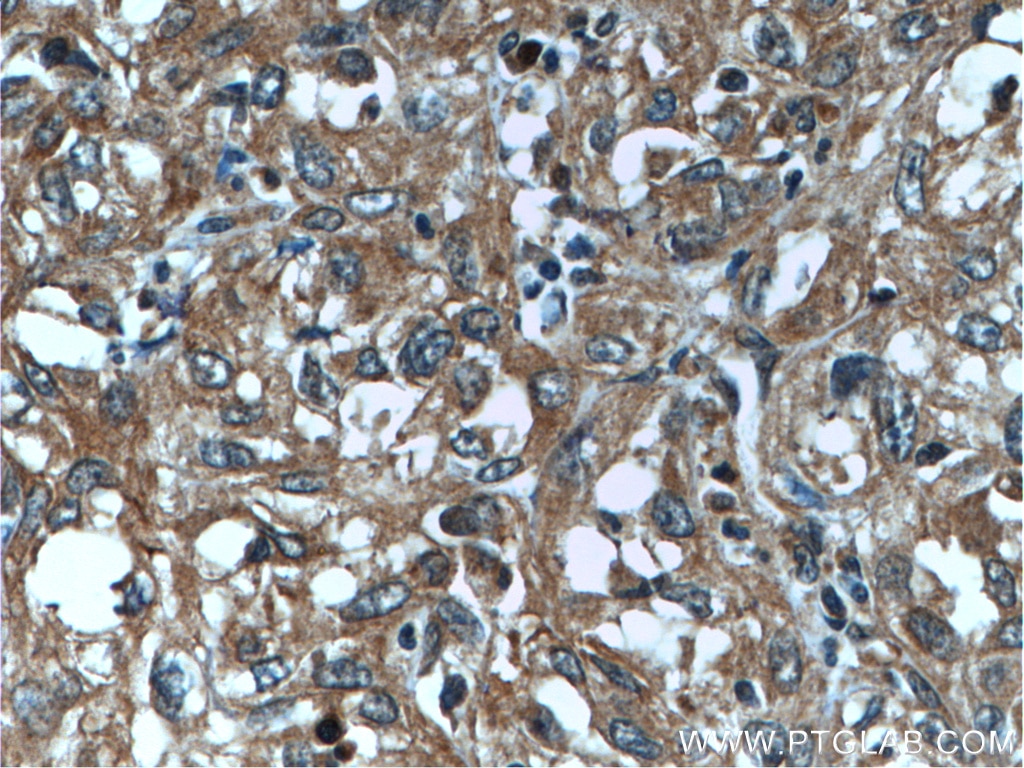 Immunohistochemistry (IHC) staining of human cervical cancer tissue using PNPLA4 Polyclonal antibody (25469-1-AP)