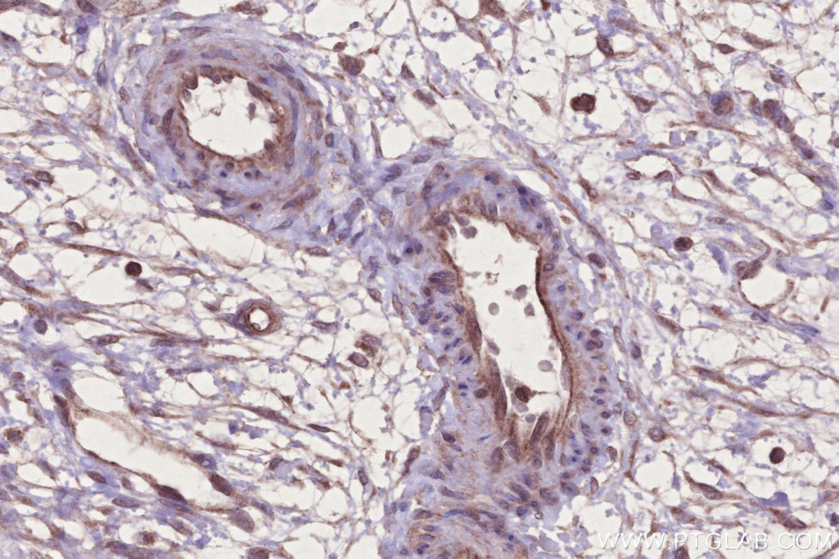Immunohistochemistry (IHC) staining of human ovary cancer tissue using PNPLA6 Polyclonal antibody (14261-1-AP)