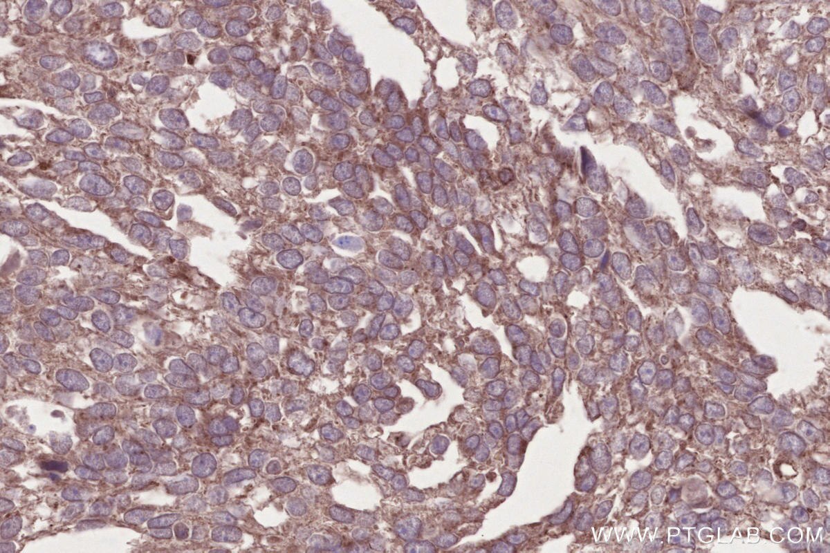 Immunohistochemistry (IHC) staining of human ovary cancer tissue using PNPLA6 Polyclonal antibody (14261-1-AP)