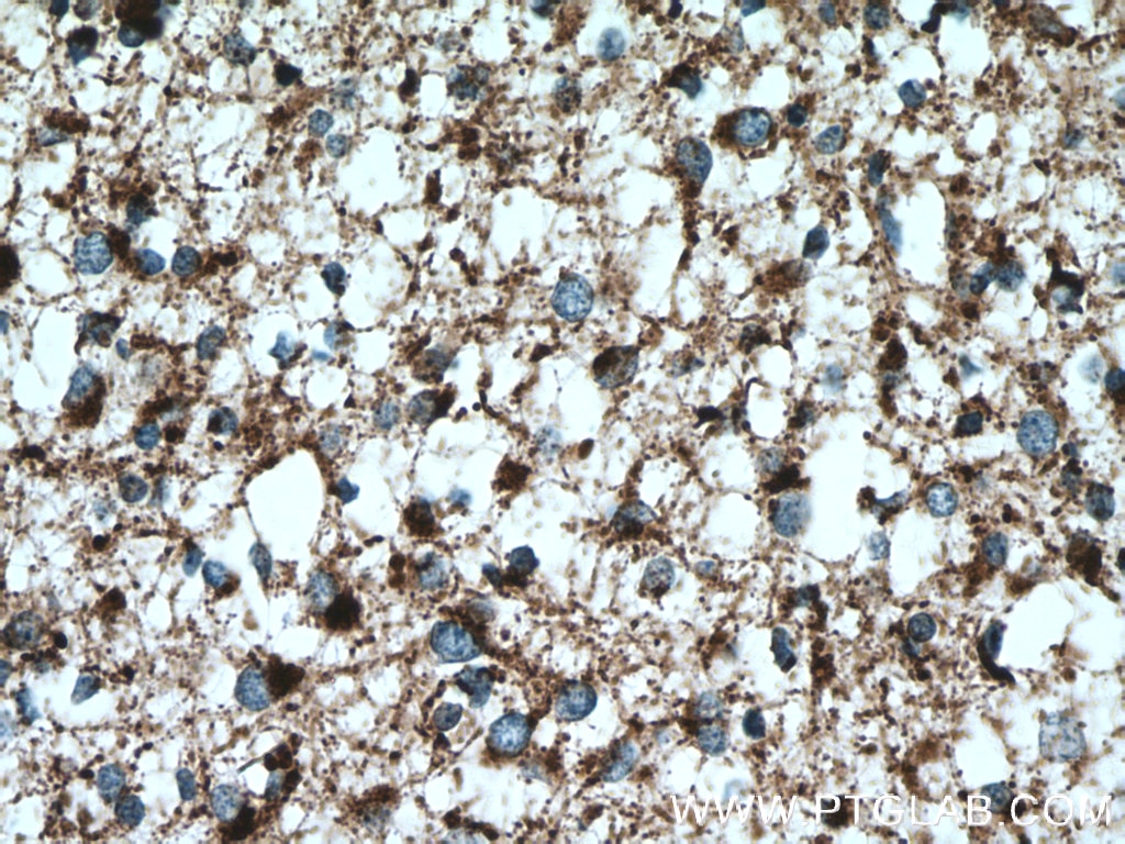 Immunohistochemistry (IHC) staining of human gliomas tissue using PNPT1 Polyclonal antibody (14487-1-AP)