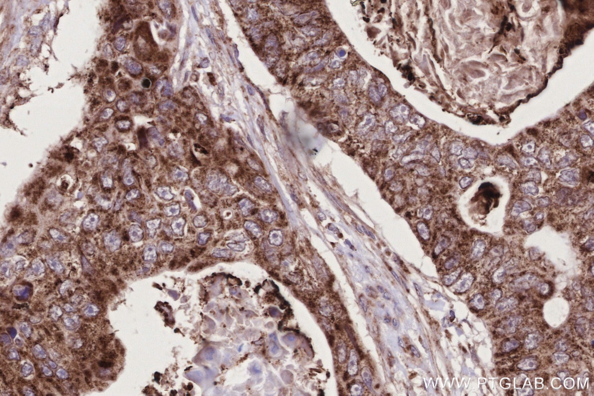 IHC staining of human stomach cancer using 14487-1-AP Immunohistochemistry (IHC) staining of human stomach cancer tissue using PNPT1 Polyclonal antibody (14487-1-AP)