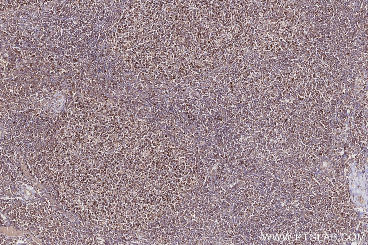IHC staining of human tonsillitis using 14487-1-AP Immunohistochemistry (IHC) staining of human tonsillitis tissue using PNPT1 Polyclonal antibody (14487-1-AP)