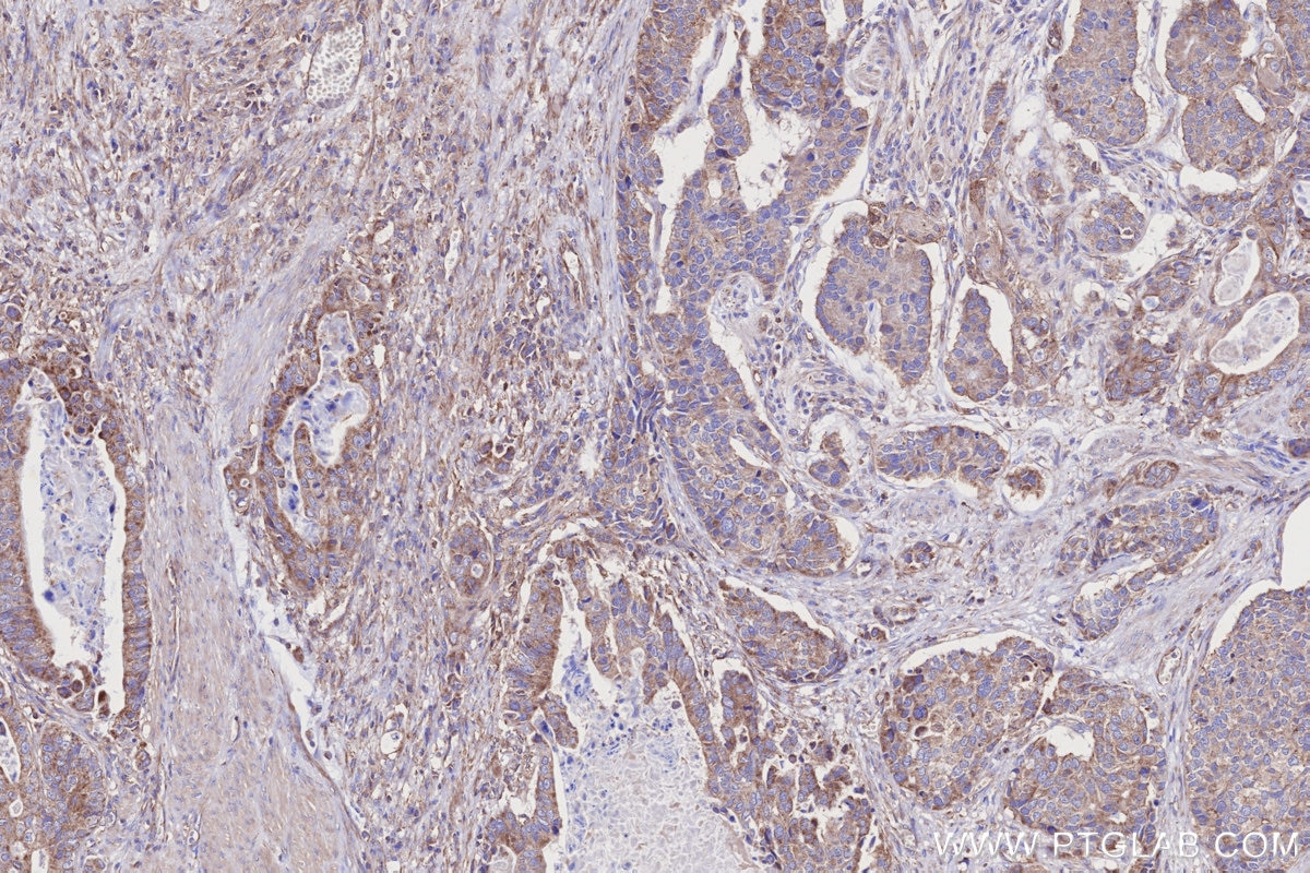 Immunohistochemistry (IHC) staining of human stomach cancer tissue using PNPT1 Monoclonal antibody (68309-1-Ig)