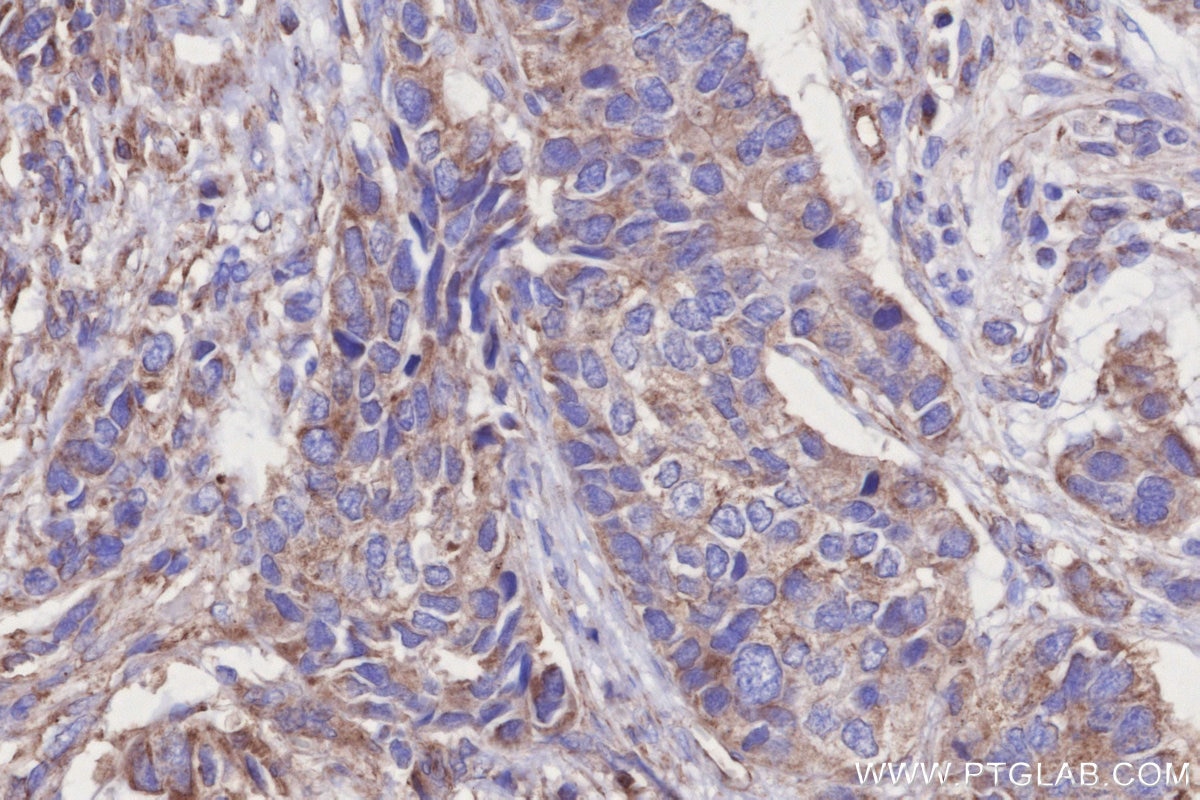 Immunohistochemistry (IHC) staining of human stomach cancer tissue using PNPT1 Monoclonal antibody (68309-1-Ig)