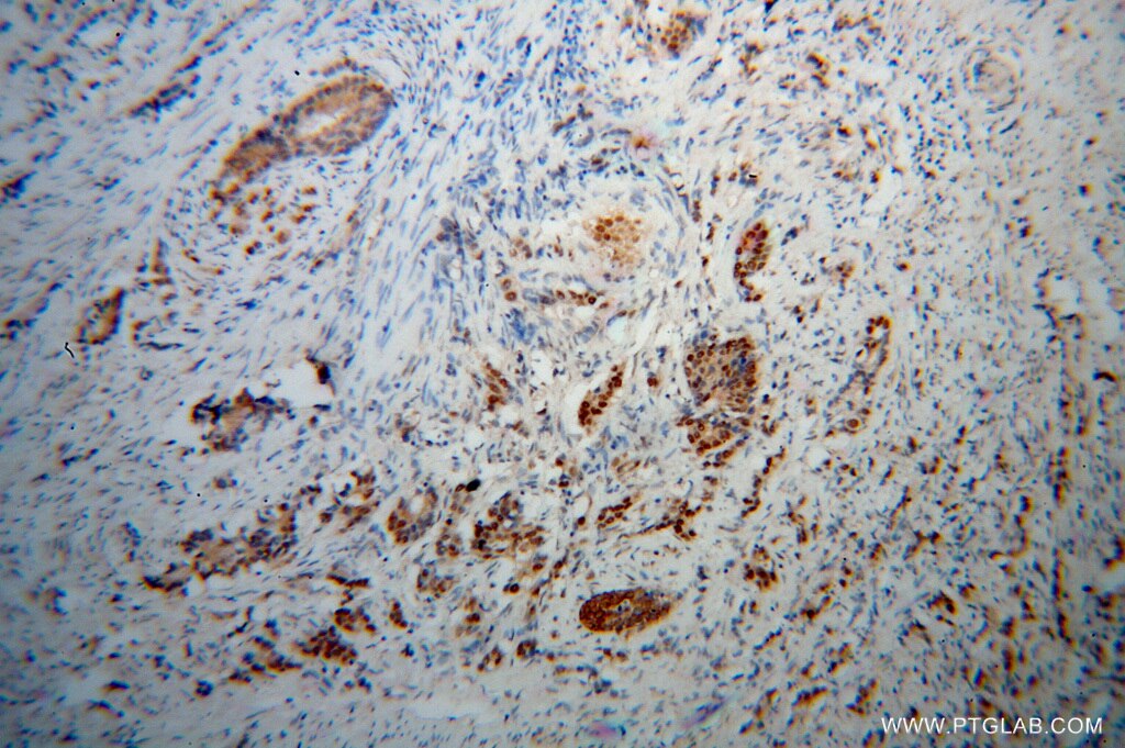 Immunohistochemistry (IHC) staining of human gliomas tissue using PNRC2 Polyclonal antibody (51050-1-AP)