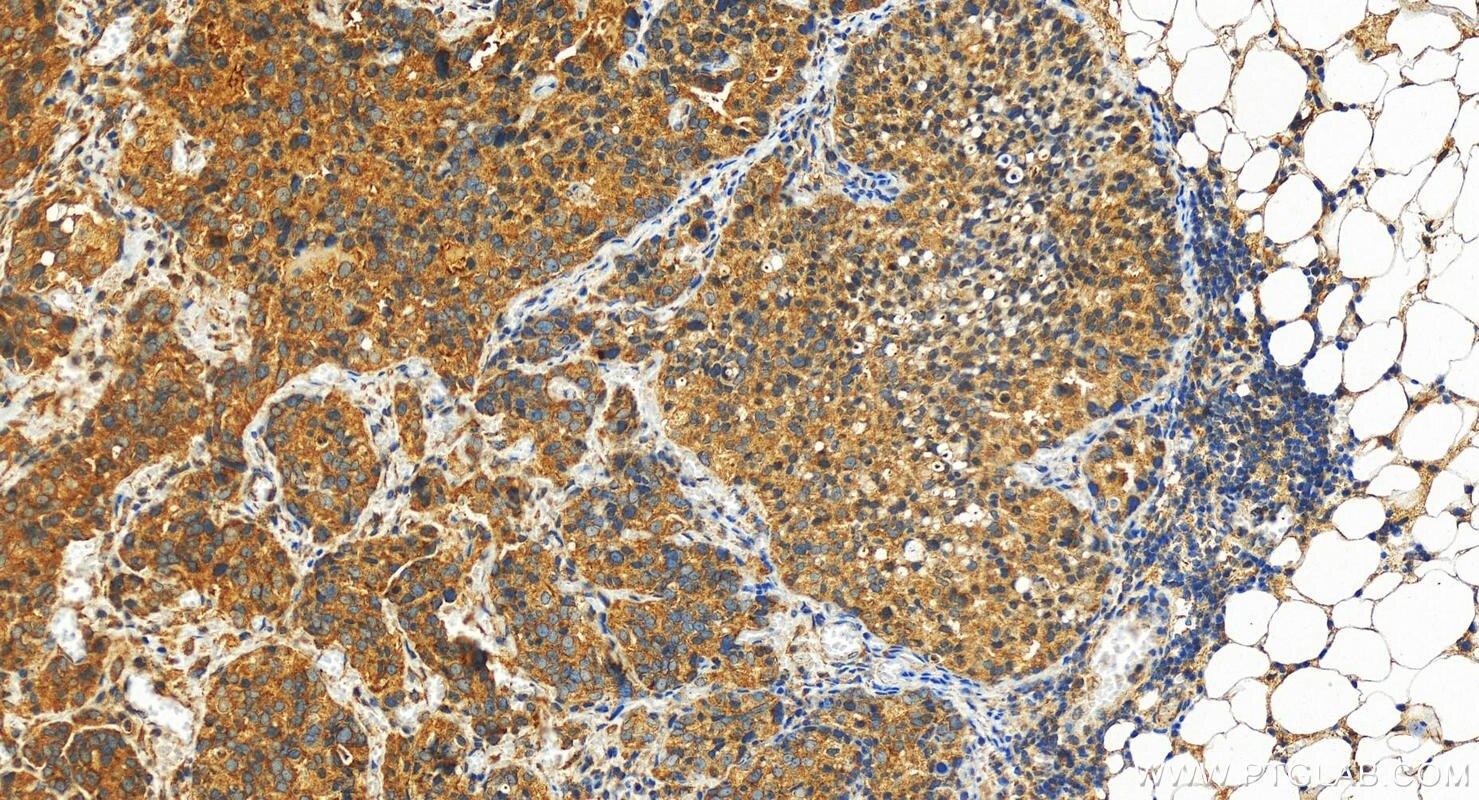 Immunohistochemistry (IHC) staining of human ovary cancer tissue using POF1B Polyclonal antibody (11398-1-AP)