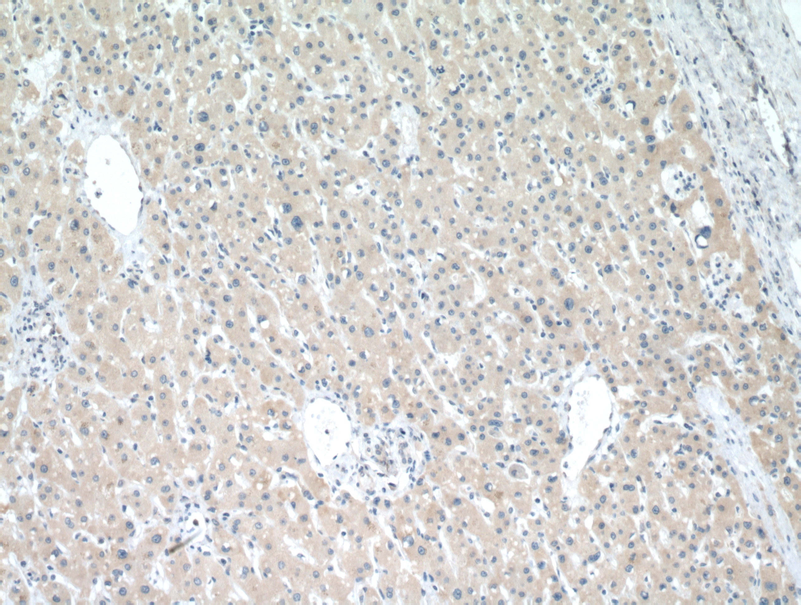 Immunohistochemistry (IHC) staining of human liver cancer tissue using POFUT1 Polyclonal antibody (14929-1-AP)