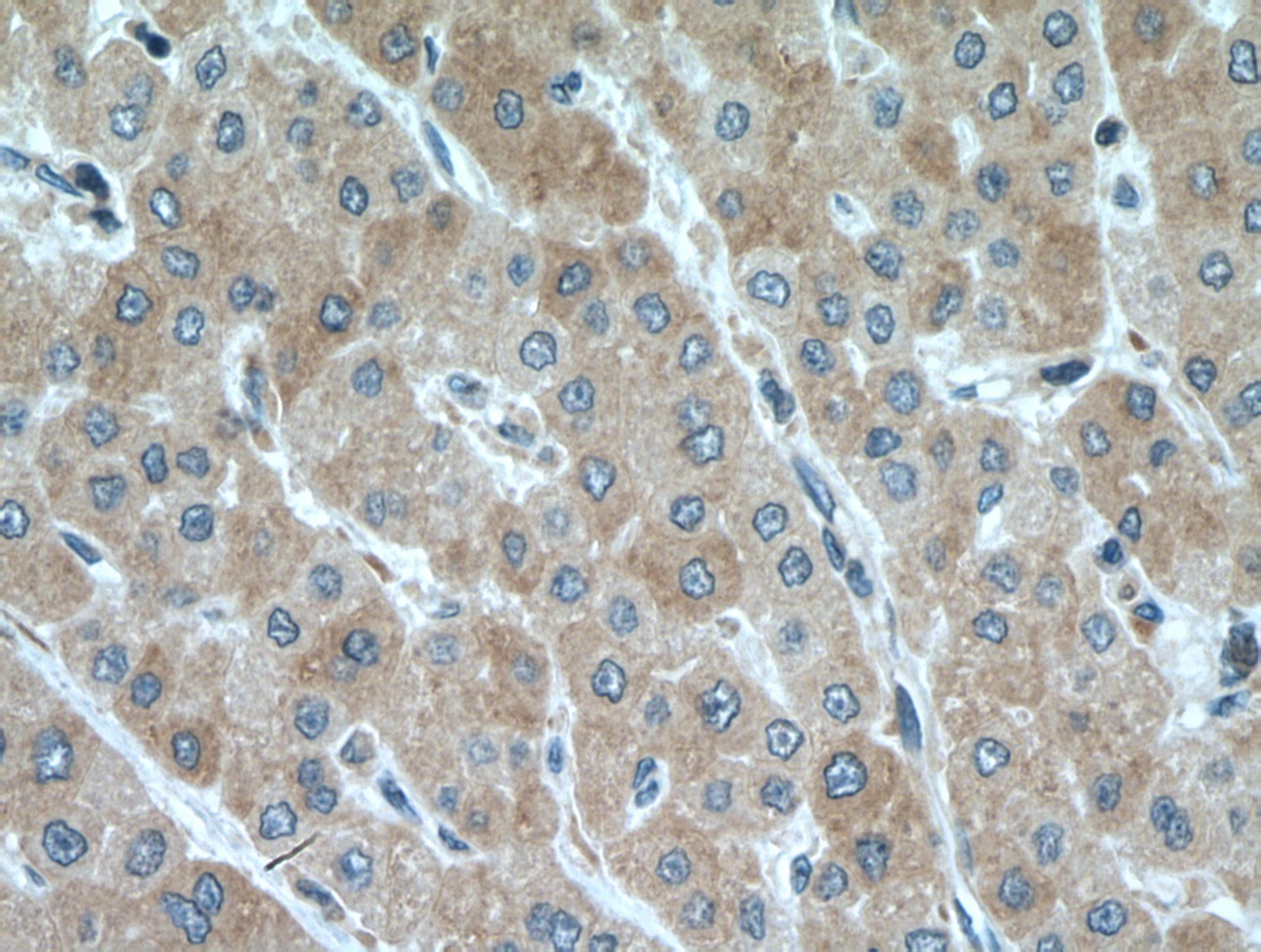 Immunohistochemistry (IHC) staining of human liver cancer tissue using POFUT1 Polyclonal antibody (14929-1-AP)