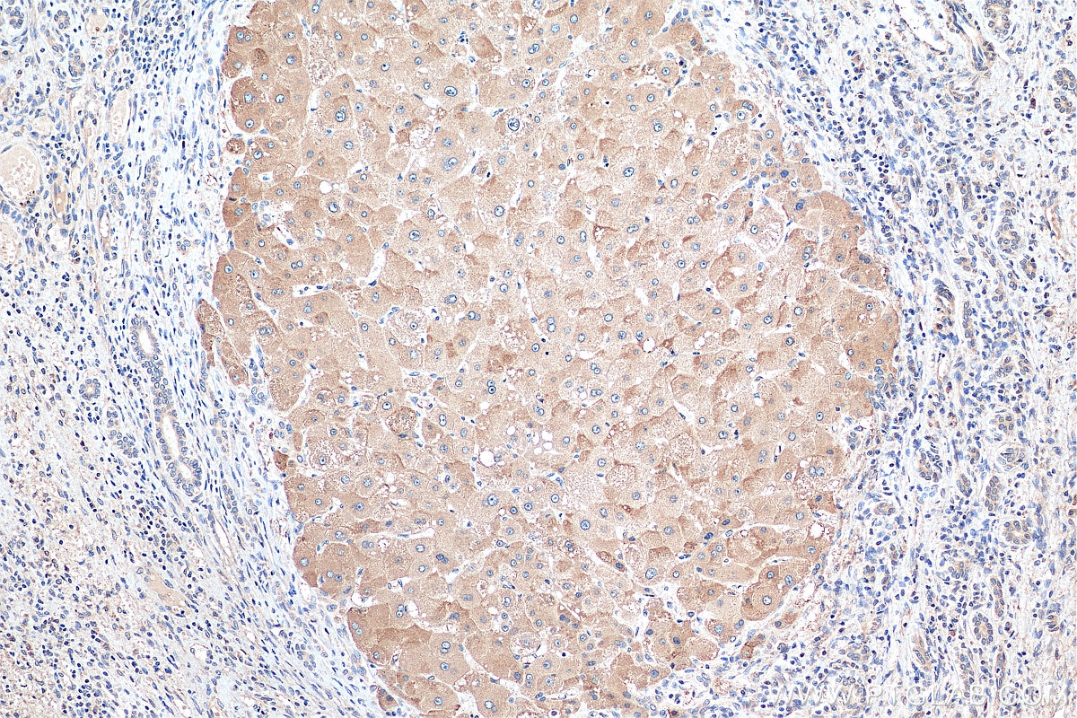 Immunohistochemistry (IHC) staining of human liver cancer tissue using POFUT1 Polyclonal antibody (14929-1-AP)