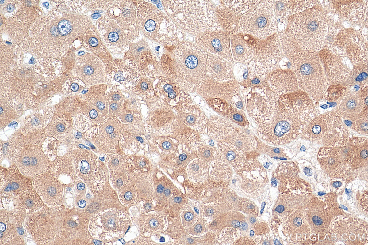 Immunohistochemistry (IHC) staining of human liver cancer tissue using POFUT1 Polyclonal antibody (14929-1-AP)