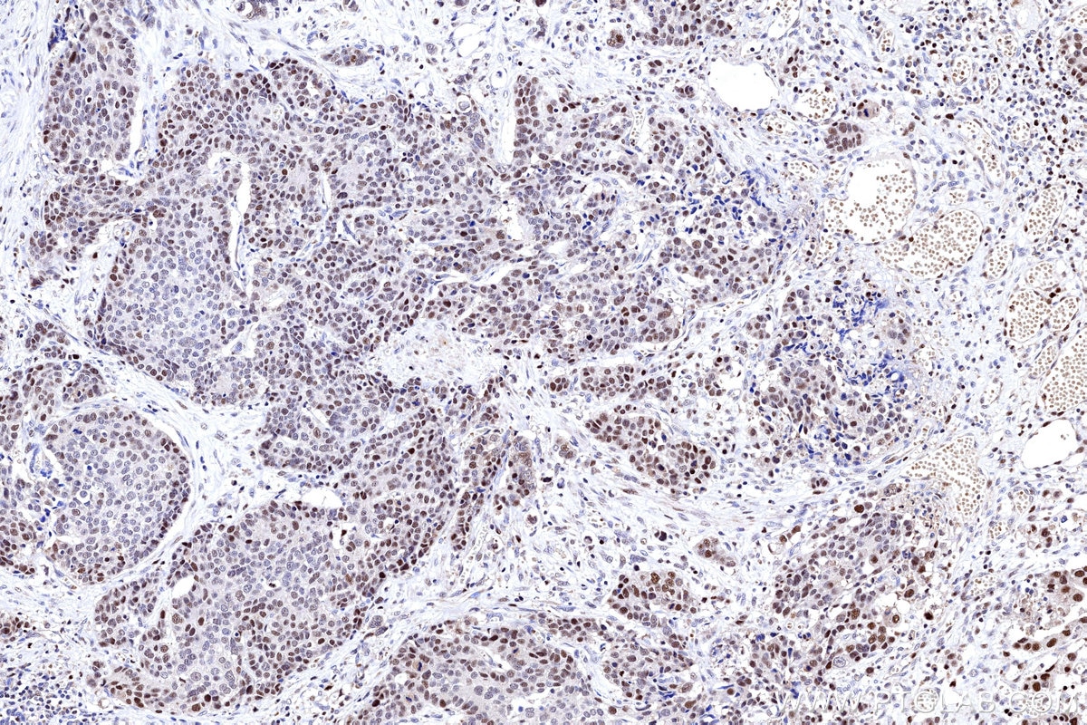 IHC staining of human stomach cancer using 31394-1-AP Immunohistochemistry (IHC) staining of human stomach cancer tissue using POLA1 Polyclonal antibody (31394-1-AP)