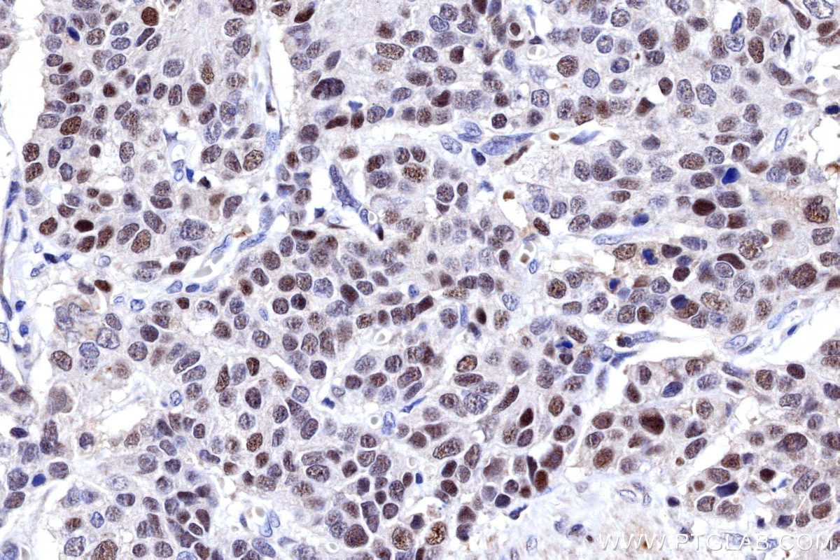 IHC staining of human stomach cancer using 31394-1-AP Immunohistochemistry (IHC) staining of human stomach cancer tissue using POLA1 Polyclonal antibody (31394-1-AP)