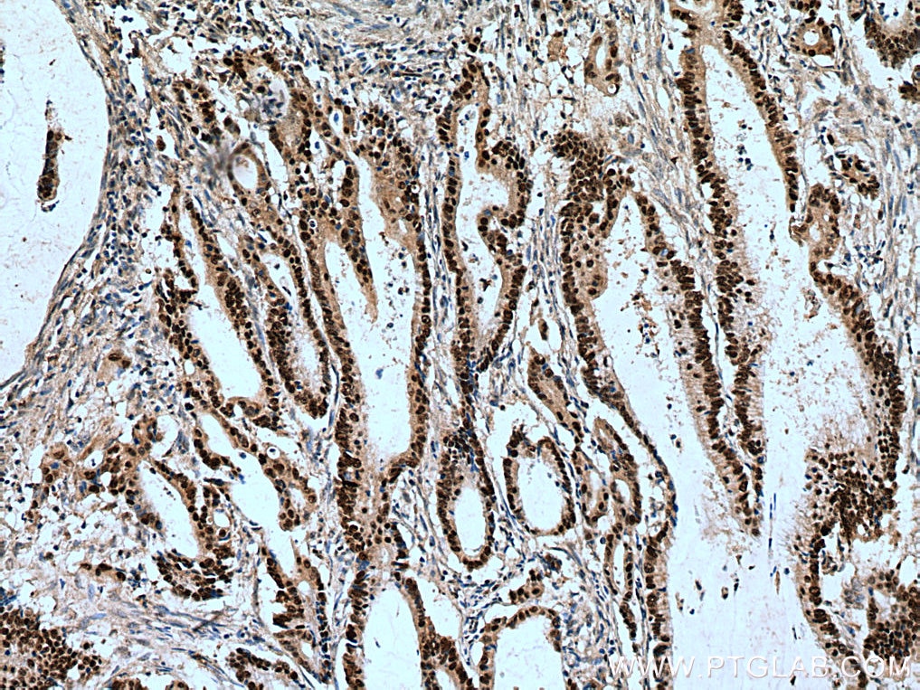 Immunohistochemistry (IHC) staining of human colon cancer tissue using POLD1 Polyclonal antibody (15646-1-AP)