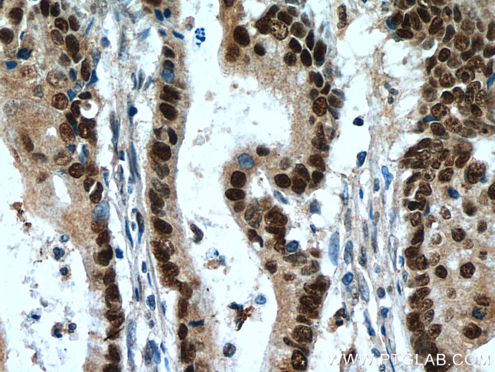 Immunohistochemistry (IHC) staining of human colon cancer tissue using POLD1 Polyclonal antibody (15646-1-AP)