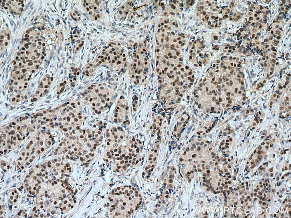 Immunohistochemistry (IHC) staining of human breast cancer tissue using POLD1 Polyclonal antibody (15646-1-AP)