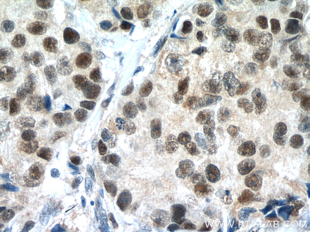 Immunohistochemistry (IHC) staining of human breast cancer tissue using POLD1 Polyclonal antibody (15646-1-AP)