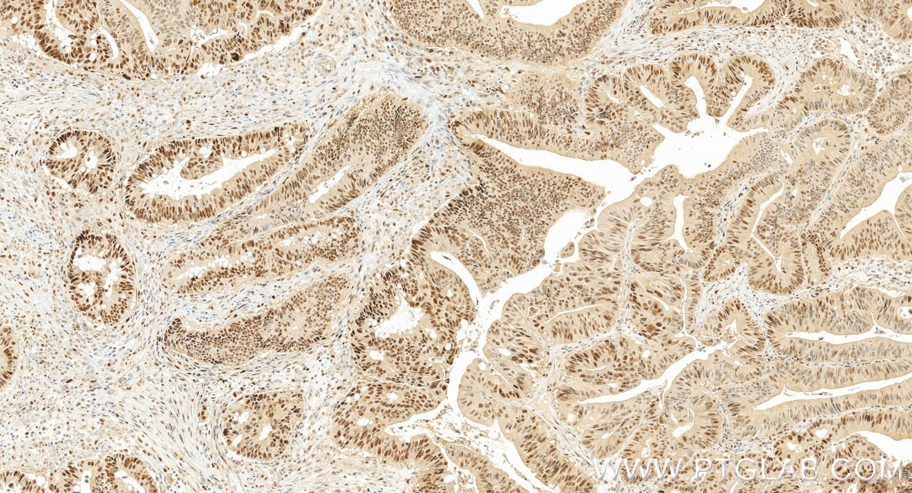 Immunohistochemistry (IHC) staining of human colon cancer tissue using POLD1 Recombinant monoclonal antibody (86197-2-RR)