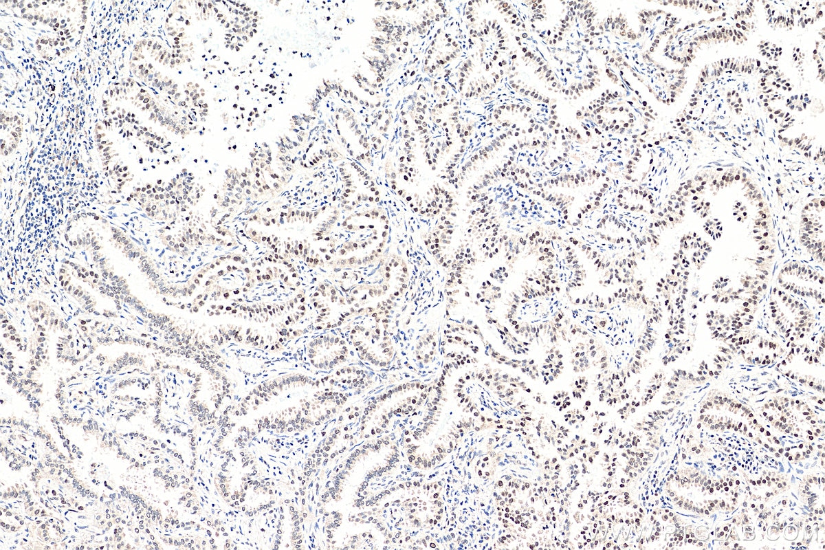 Immunohistochemistry (IHC) staining of human lung cancer tissue using POLD2 Polyclonal antibody (29765-1-AP)