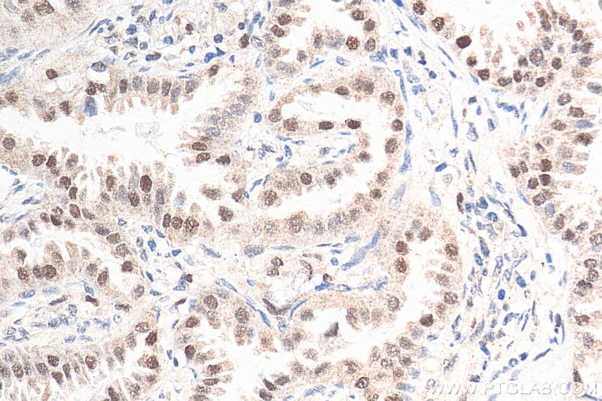 Immunohistochemistry (IHC) staining of human lung cancer tissue using POLD2 Polyclonal antibody (29765-1-AP)