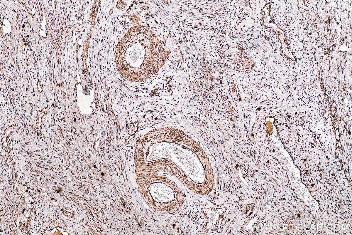 IHC staining of human cervical cancer using 21935-1-AP