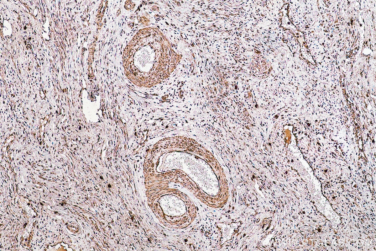 Immunohistochemistry (IHC) staining of human cervical cancer tissue using POLD3 Polyclonal antibody (21935-1-AP)