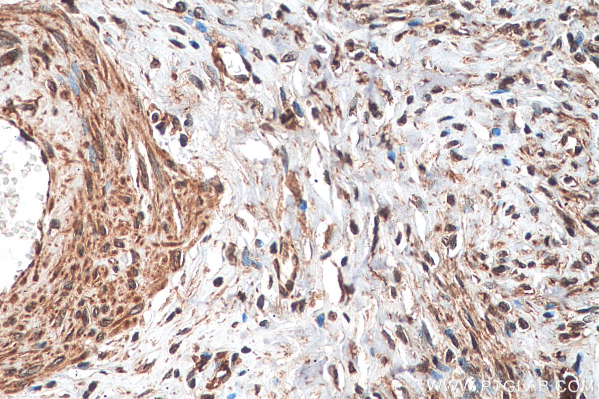 Immunohistochemistry (IHC) staining of human cervical cancer tissue using POLD3 Polyclonal antibody (21935-1-AP)