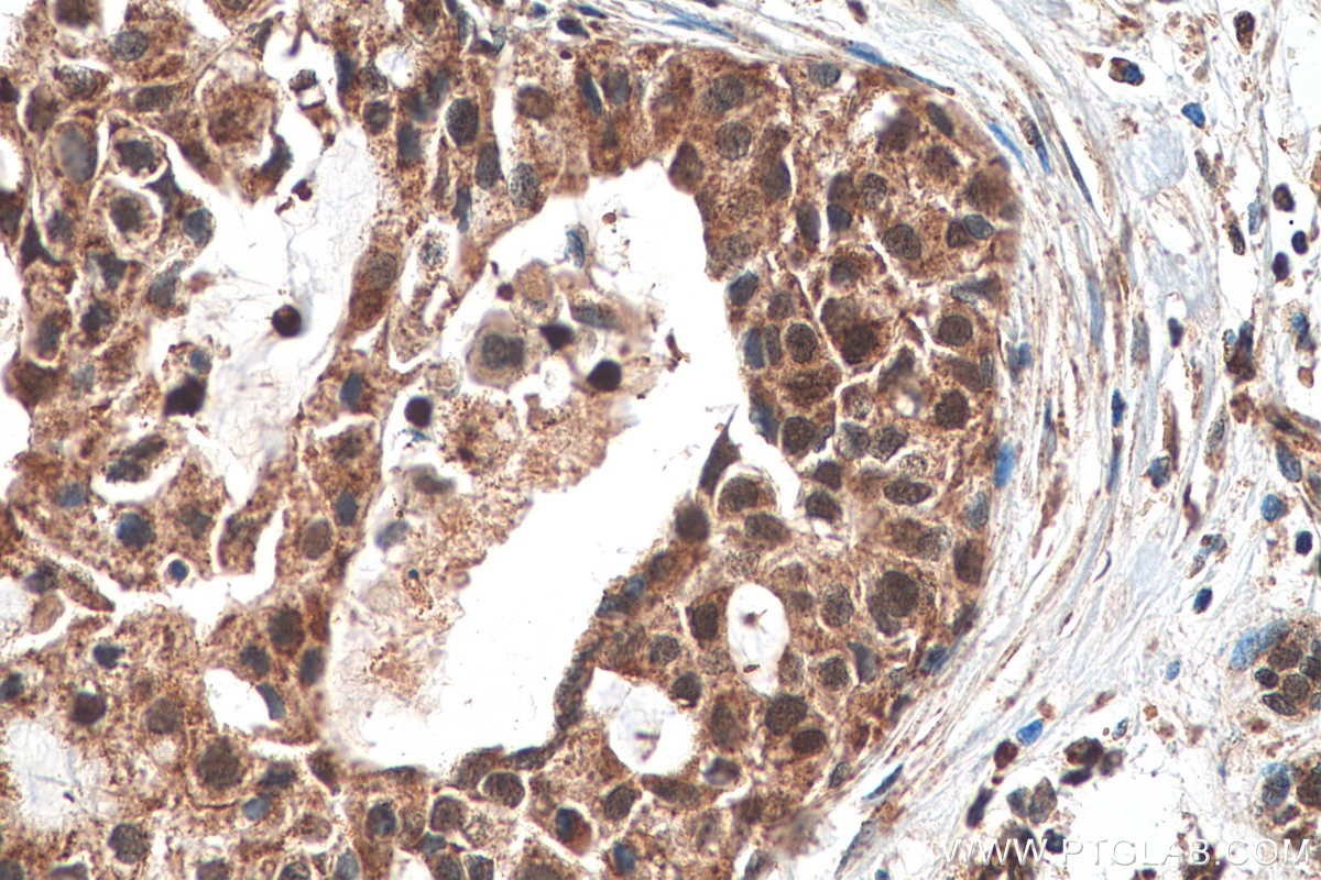 Immunohistochemistry (IHC) staining of human breast cancer tissue using POLD3 Polyclonal antibody (21935-1-AP)