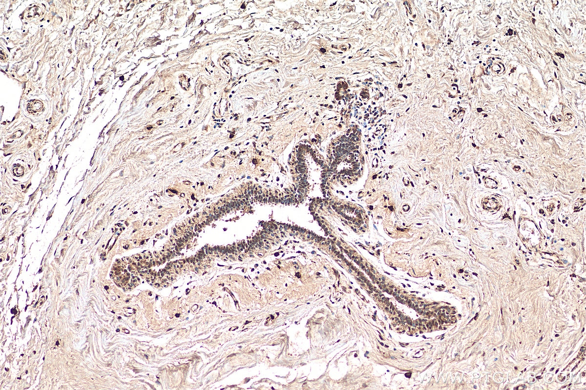 Immunohistochemistry (IHC) staining of human breast cancer tissue using POLD3 Polyclonal antibody (21935-1-AP)